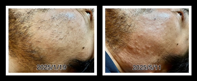 浜松ヒゲ脱毛日記