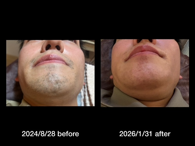 浜松髭脱毛日記